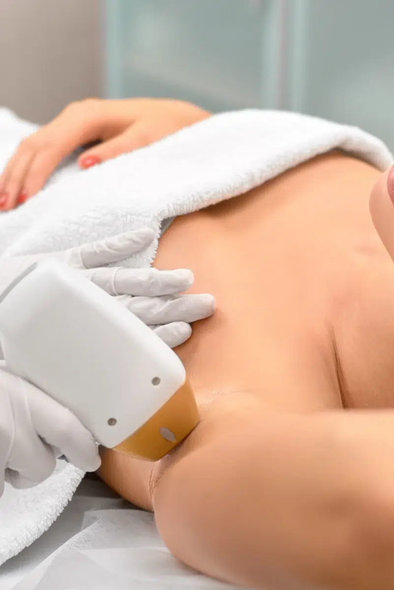 Épilation au laser des aisselles