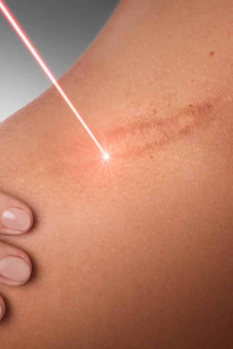 Traitement laser sur cicatrice
