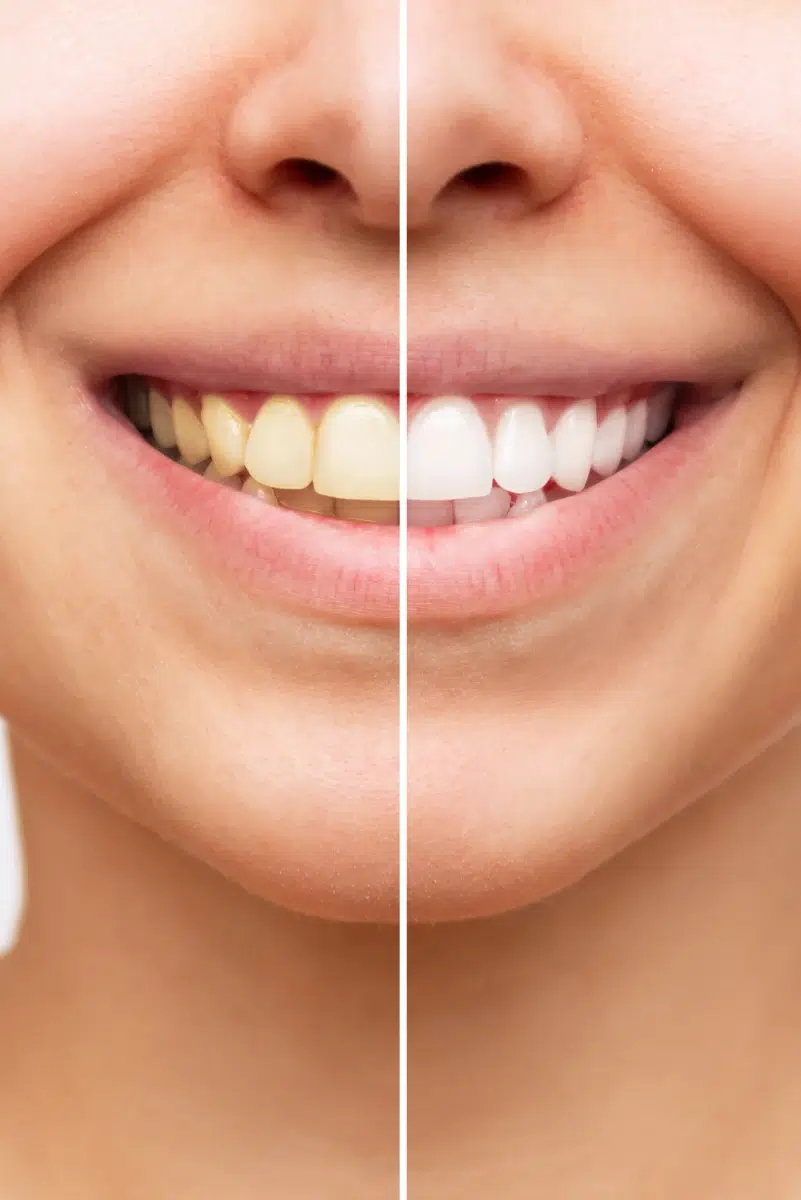 Comparaison de dents avant et après blanchiment